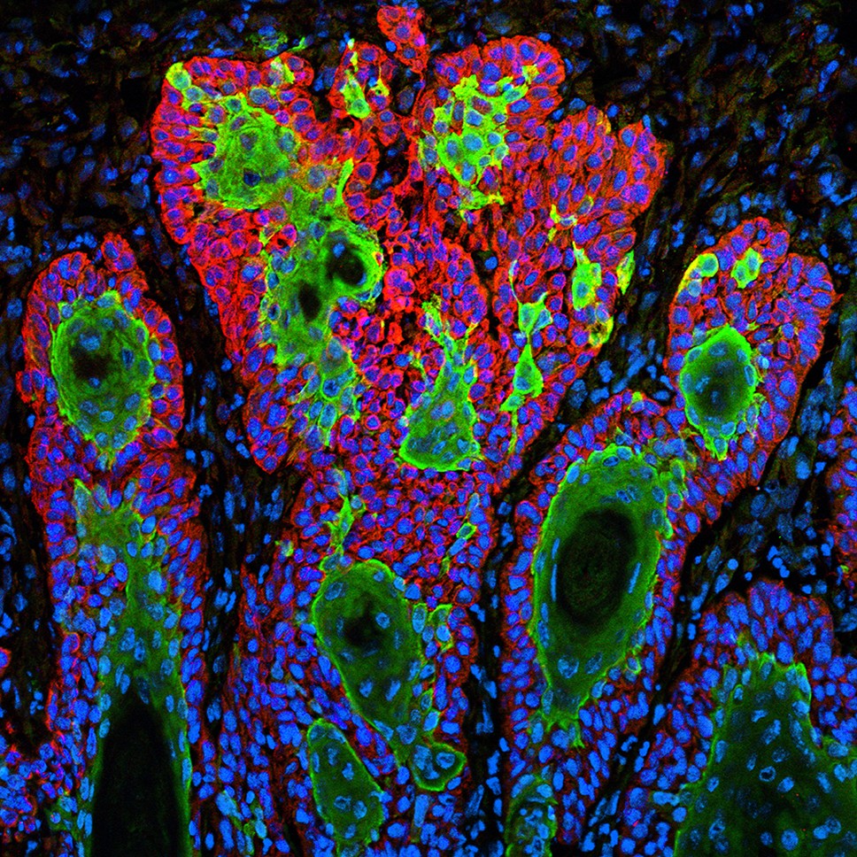 schober-fuchs-carcinoma.jpg